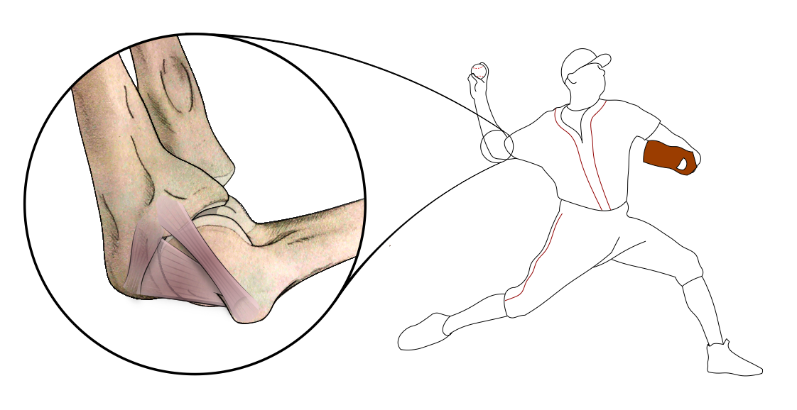 A baseball pitcher with a magnified view of the medial elbow showing the ulnar collateral ligament and its relationship to the elbow bones.